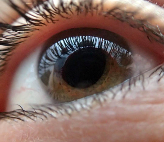 Katarakta – siva mrena Katarakt