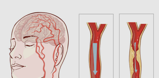 Kako da prepoznate moždani udar?