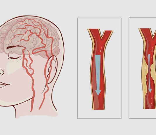 Kako da prepoznate moždani udar?