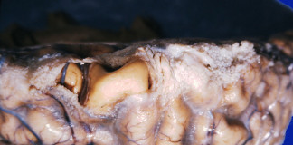 Zašto je važna pneumokokna vakcinacija?