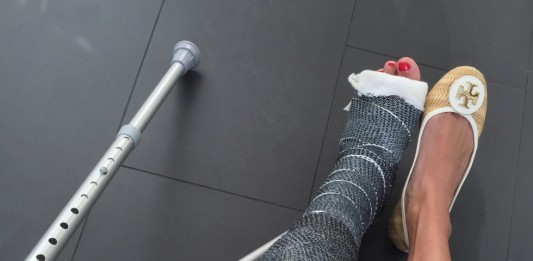 Plastični gips potiskuje stari: udobniji, lakši i više fensi!