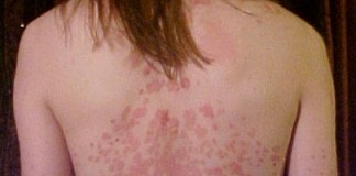 Za psorijazu dostupne efikasne terapije, pacijenti nedovoljno svesni toga