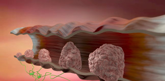 Uđite i pogledajte kako izgleda karcinom debelog creva!