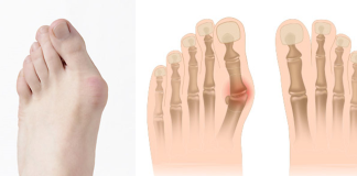 Bowen metodom protiv čukljeva