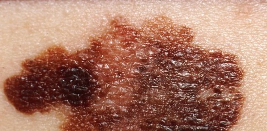 Novim terapijama protiv melanoma, solarijumi pod strogom kontrolom