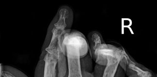 Ne odlaži i uoči rano artitis