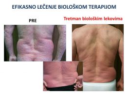 Najteži pacijenti oboleli od psorijaze u Srbiji na korak do biološke terapije