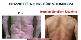Najteži pacijenti oboleli od psorijaze u Srbiji na korak do biološke terapije
